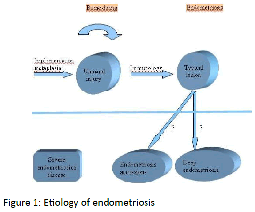 reproductive-immunology-Etiology-endometriosis