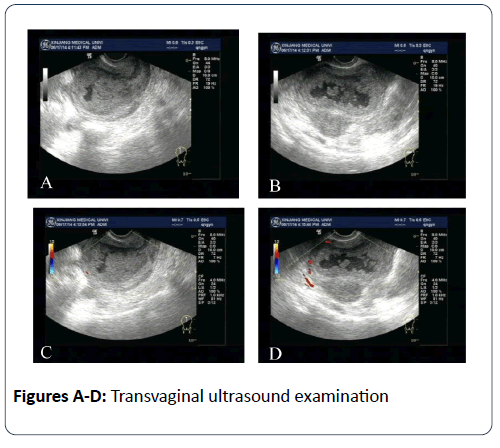 reproductive-immunology-Transvaginal-ultrasound